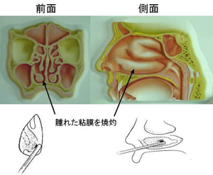 粘膜 痛い 鼻